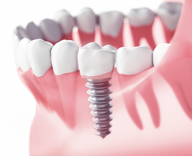 Імплантація